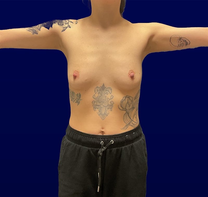 Breast Augmentation Before & After Gallery - Patient 118903 - Image 3