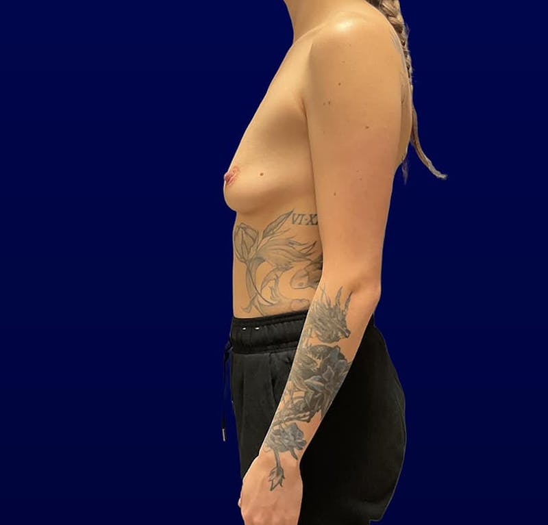 Breast Augmentation Before & After Gallery - Patient 118903 - Image 7