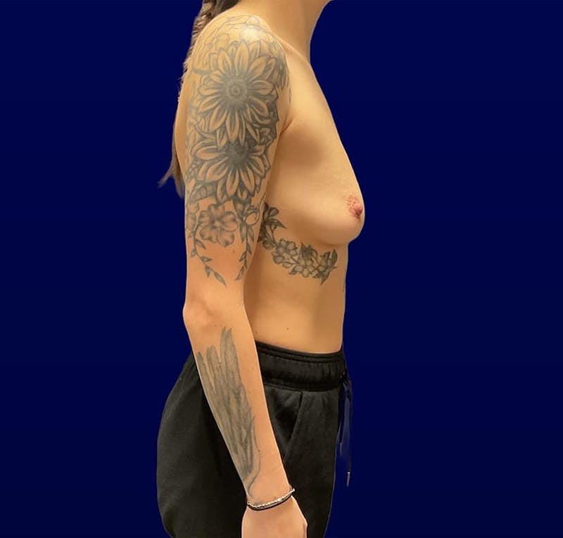 Breast Augmentation Before & After Gallery - Patient 118903 - Image 11