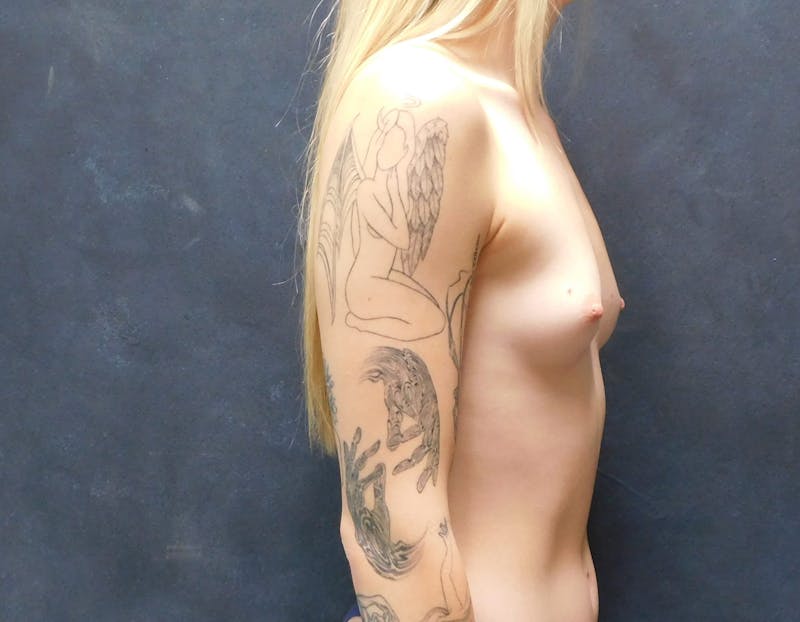 Breast Augmentation Before & After Gallery - Patient 374591 - Image 7