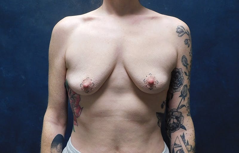 Breast Augmentation Before & After Gallery - Patient 282105 - Image 1