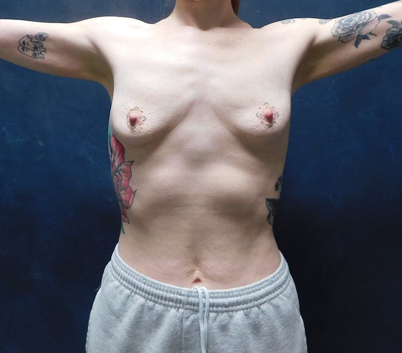 Breast Augmentation Before & After Gallery - Patient 282105 - Image 3