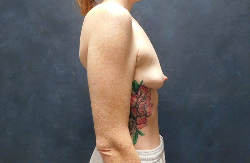 Breast Augmentation Before & After Gallery - Patient 282105 - Image 7