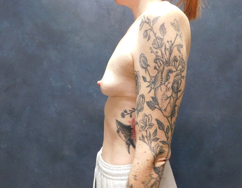 Breast Augmentation Before & After Gallery - Patient 282105 - Image 11