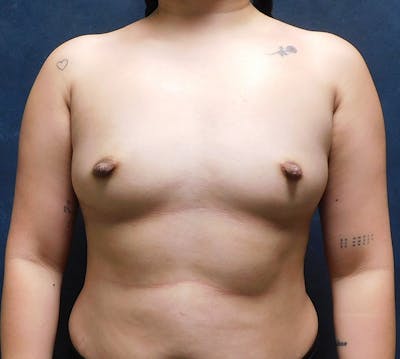 Breast Augmentation Before & After Gallery - Patient 402007 - Image 1