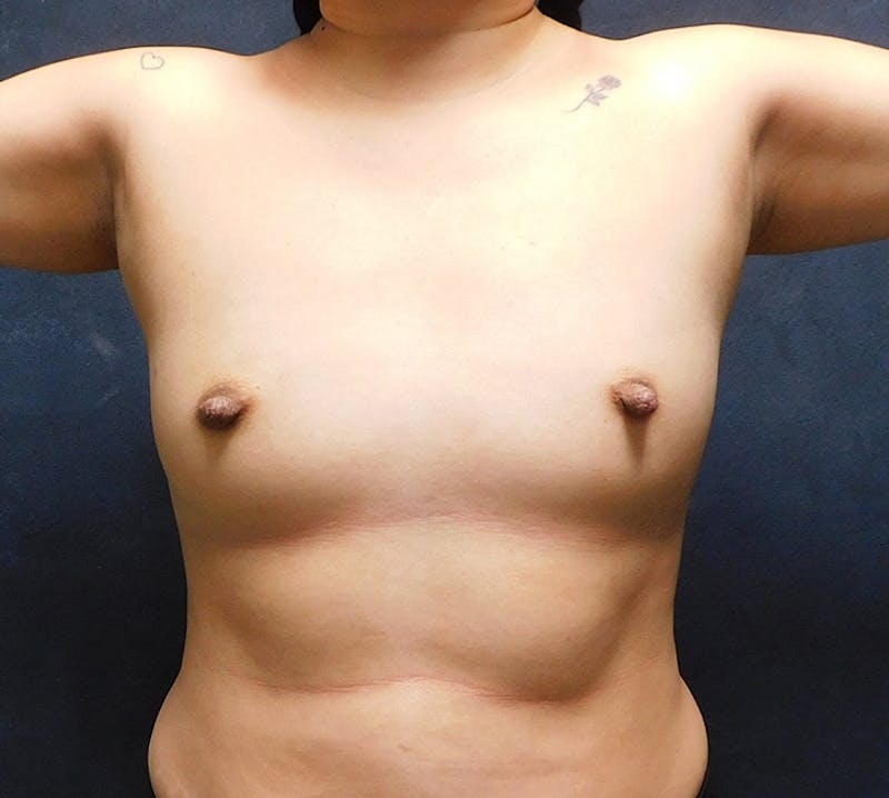 Breast Augmentation Before & After Gallery - Patient 402007 - Image 3