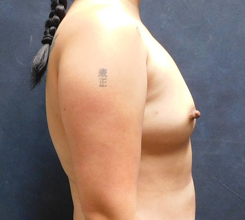 Breast Augmentation Before & After Gallery - Patient 402007 - Image 11
