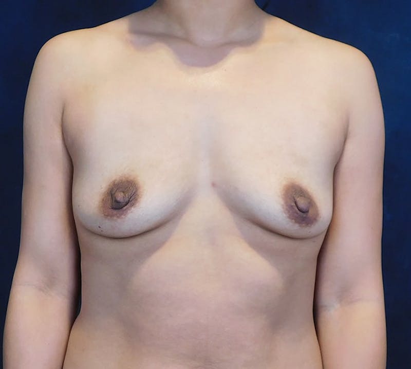 Breast Augmentation Before & After Gallery - Patient 393093 - Image 1