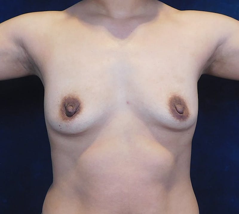Breast Augmentation Before & After Gallery - Patient 393093 - Image 3