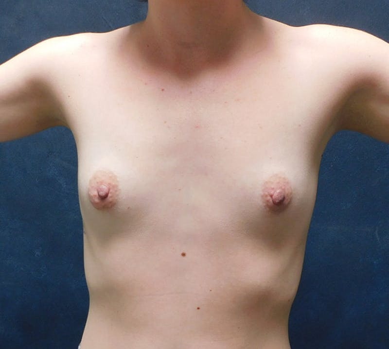 Breast Augmentation Before & After Gallery - Patient 253992 - Image 3