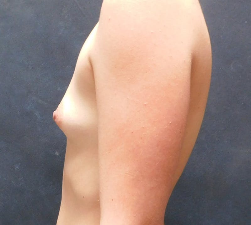 Breast Augmentation Before & After Gallery - Patient 253992 - Image 7