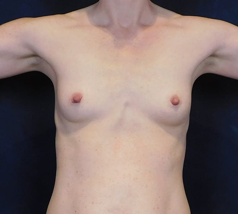 Breast Augmentation Before & After Gallery - Patient 361420 - Image 3