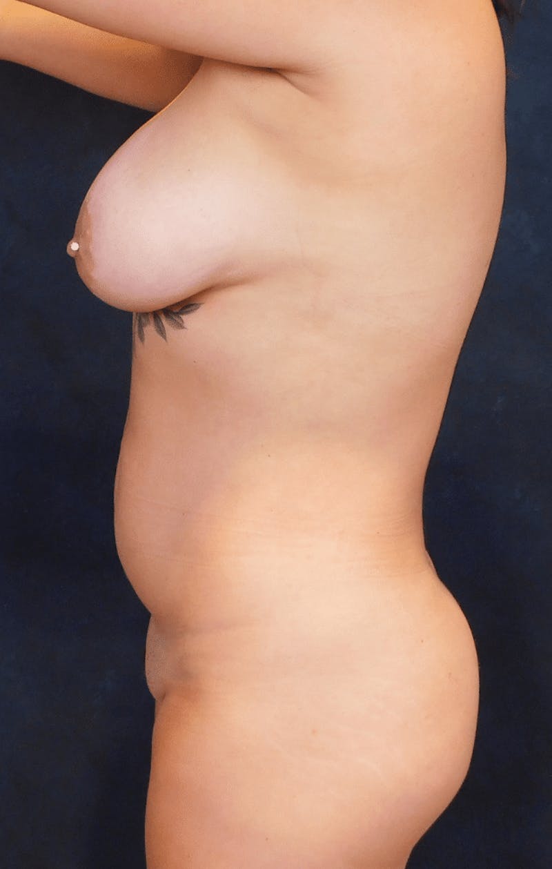 Breast Augmentation Before & After Gallery - Patient 370692 - Image 6