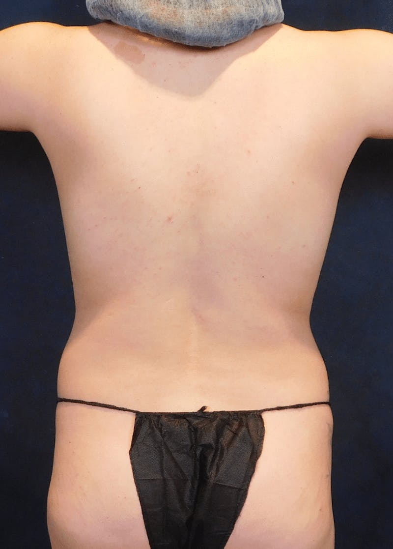 Breast Augmentation Before & After Gallery - Patient 370692 - Image 9