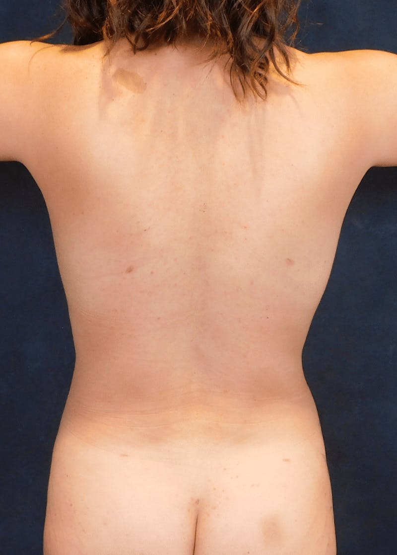 Breast Augmentation Before & After Gallery - Patient 370692 - Image 10
