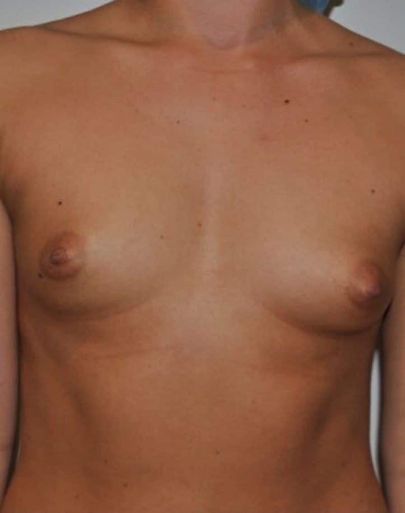 Breast Augmentation Before & After Gallery - Patient 110157 - Image 1