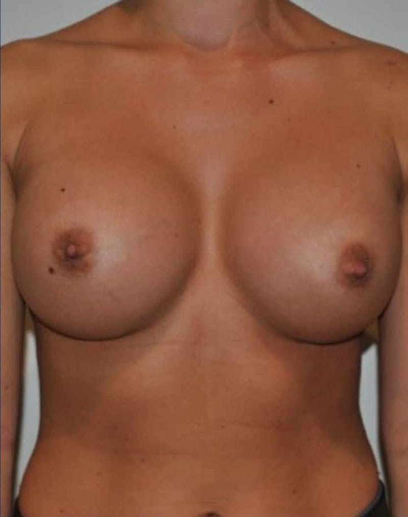 Breast Augmentation Before & After Gallery - Patient 110157 - Image 2