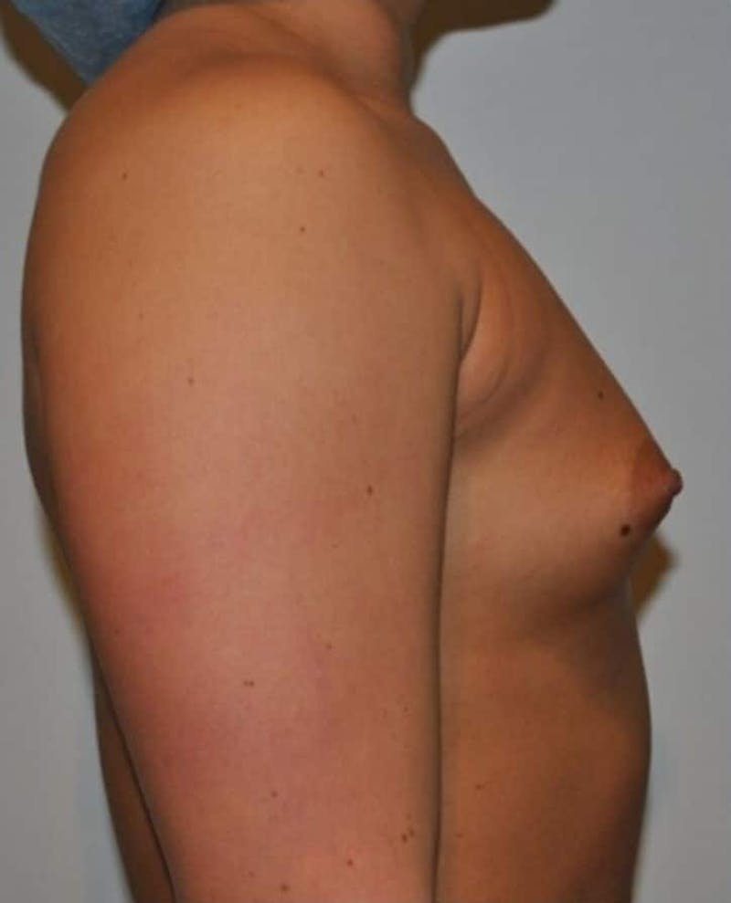 Breast Augmentation Before & After Gallery - Patient 110157 - Image 7