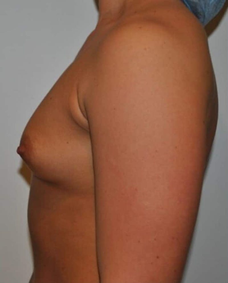 Breast Augmentation Before & After Gallery - Patient 110157 - Image 9