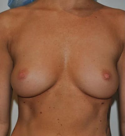 Breast Augmentation Before & After Gallery - Patient 307138 - Image 1