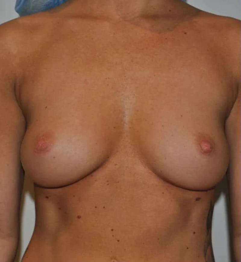 Breast Augmentation Before & After Gallery - Patient 307138 - Image 1