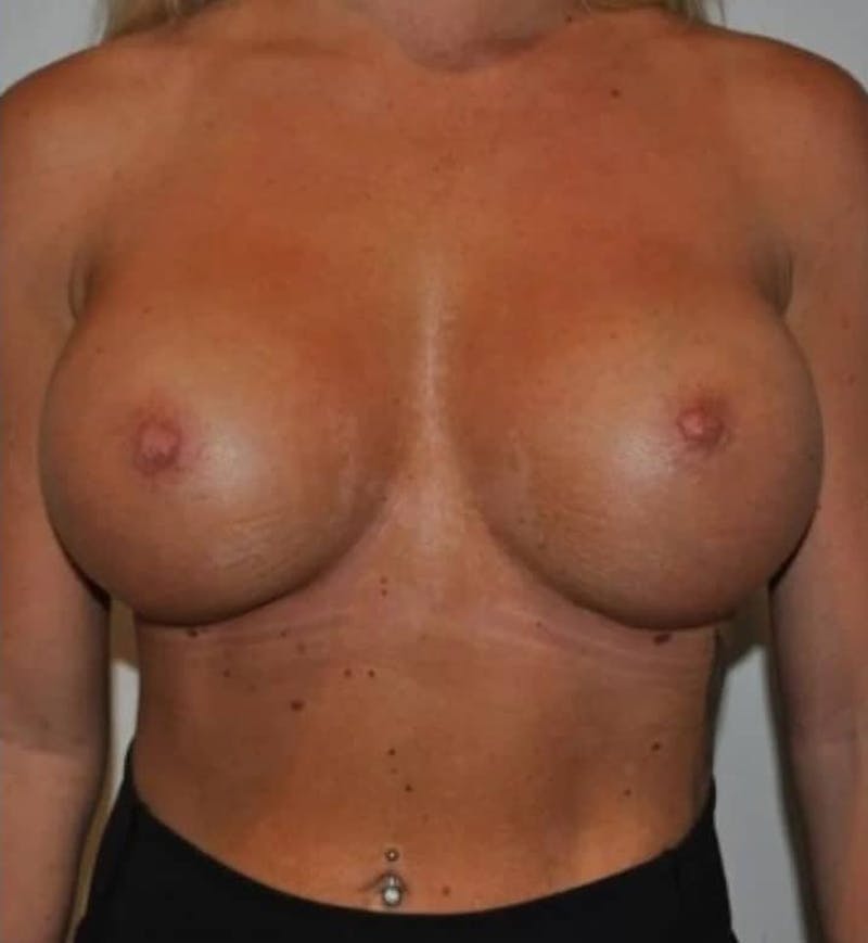 Breast Augmentation Before & After Gallery - Patient 307138 - Image 2