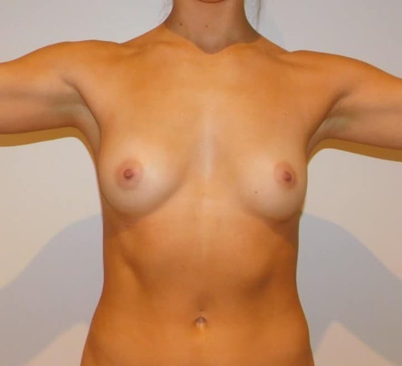 Breast Augmentation Before & After Gallery - Patient 100763 - Image 3
