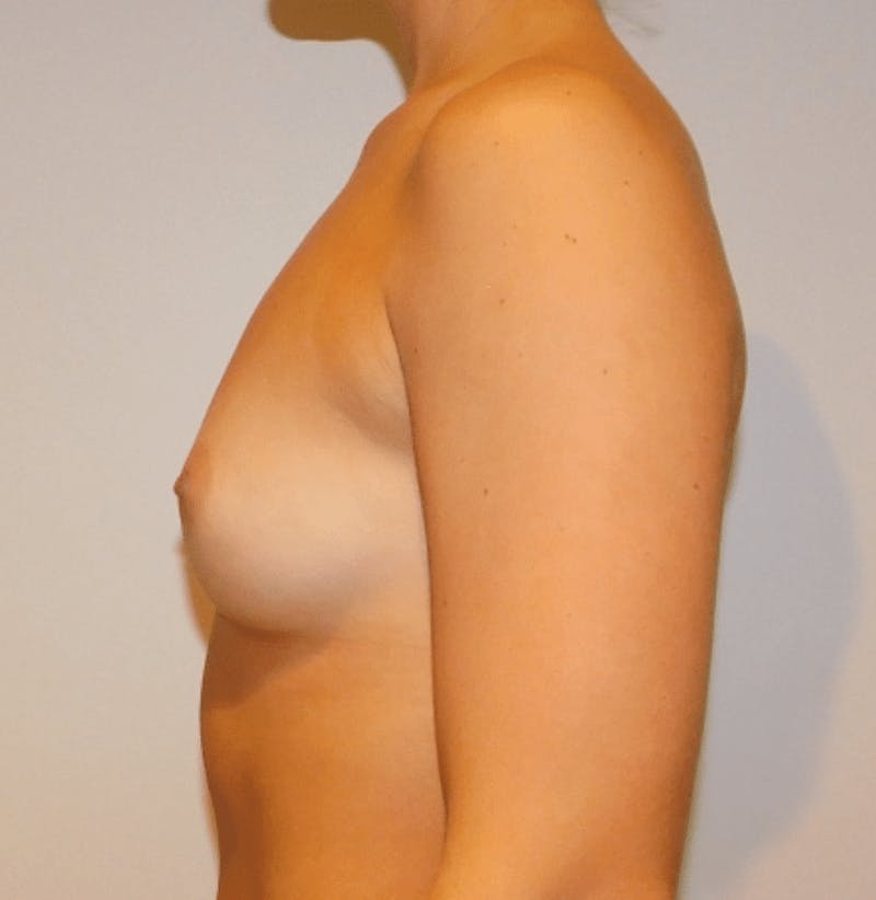 Breast Augmentation Before & After Gallery - Patient 100763 - Image 11