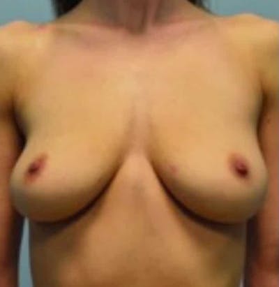 Breast Augmentation Before & After Gallery - Patient 644142 - Image 1