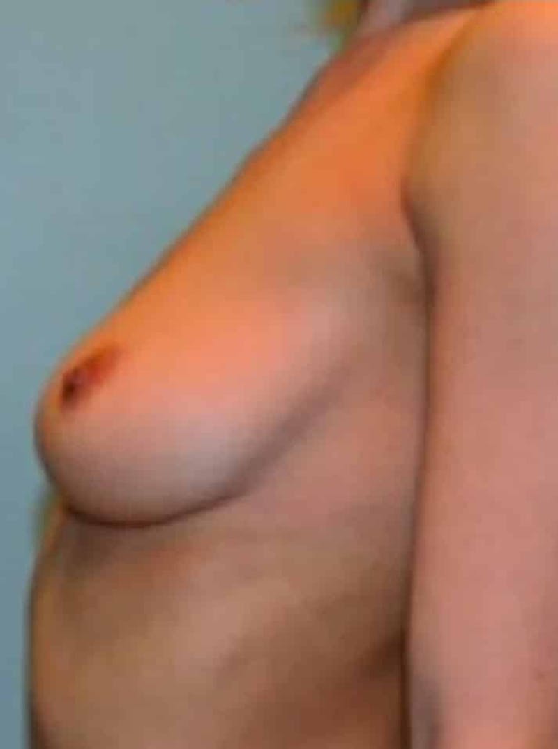 Breast Augmentation Before & After Gallery - Patient 644142 - Image 5