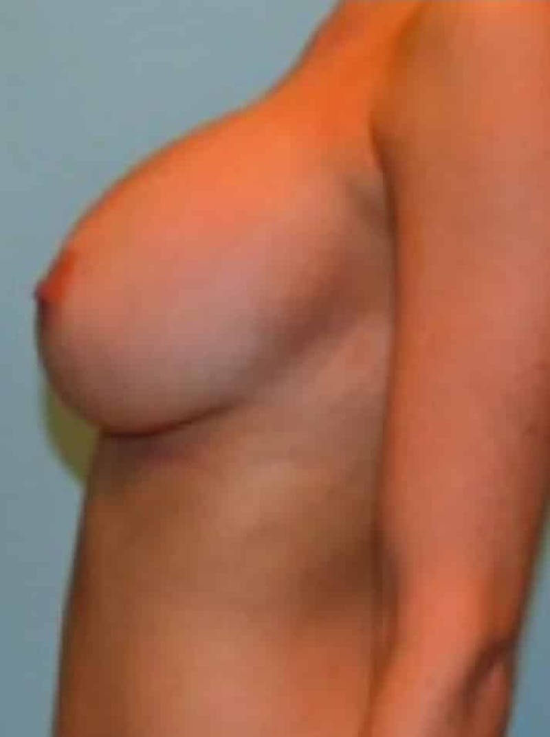 Breast Augmentation Before & After Gallery - Patient 644142 - Image 6