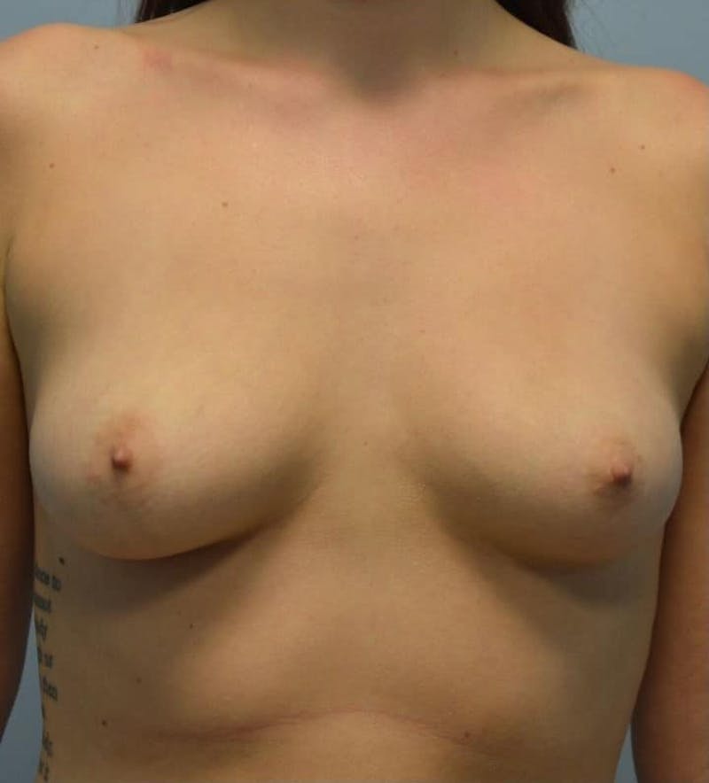 Breast Augmentation Before & After Gallery - Patient 908170 - Image 1