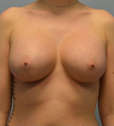 Breast Augmentation Before & After Gallery - Patient 908170 - Image 2