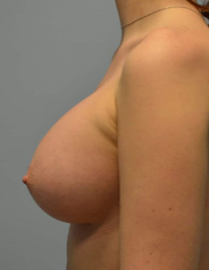 Breast Augmentation Before & After Gallery - Patient 908170 - Image 6