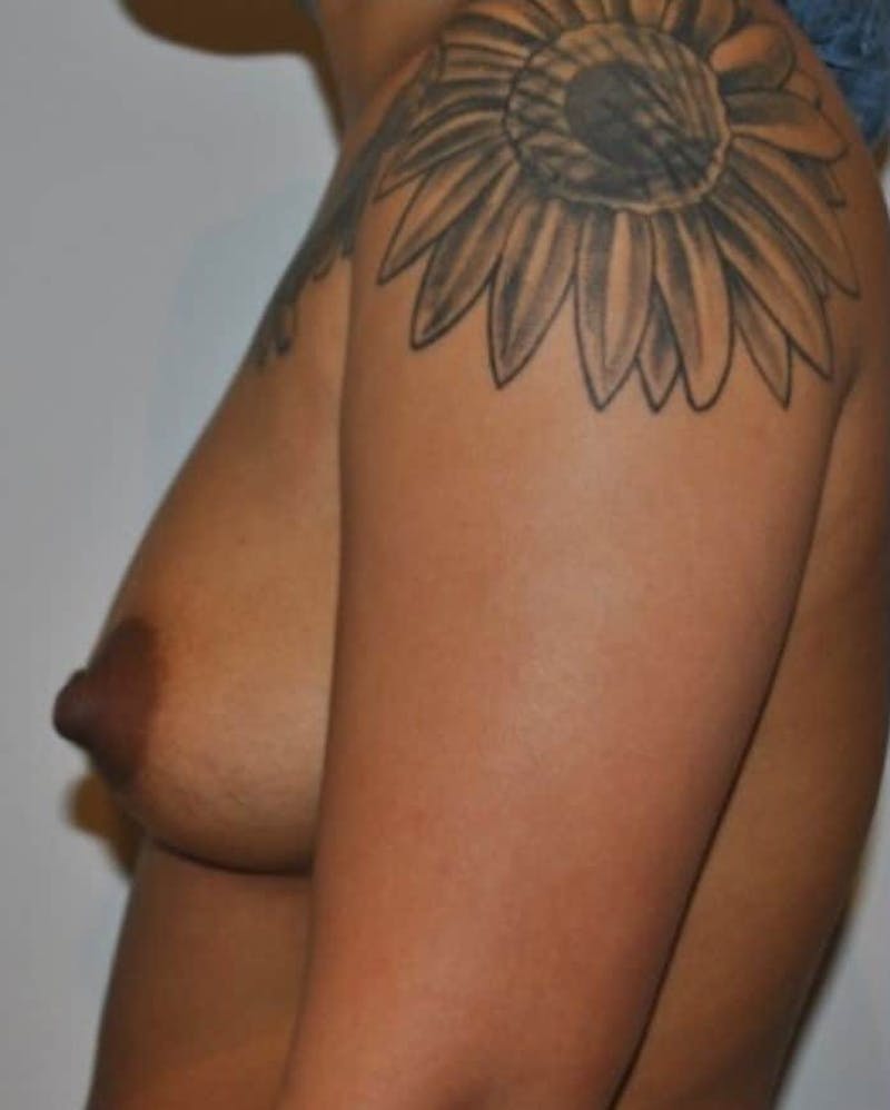 Breast Augmentation Before & After Gallery - Patient 263544 - Image 3