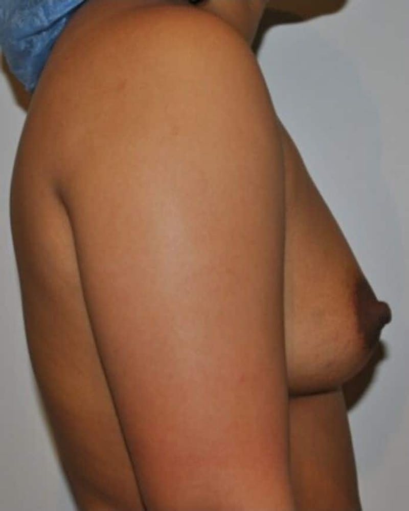 Breast Augmentation Before & After Gallery - Patient 263544 - Image 5