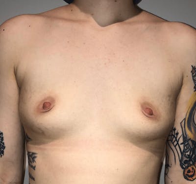 Breast Augmentation Before & After Gallery - Patient 107885 - Image 1