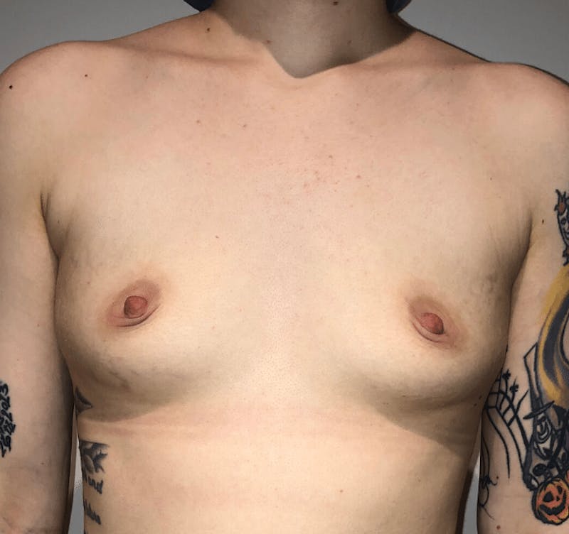 Breast Augmentation Before & After Gallery - Patient 107885 - Image 1