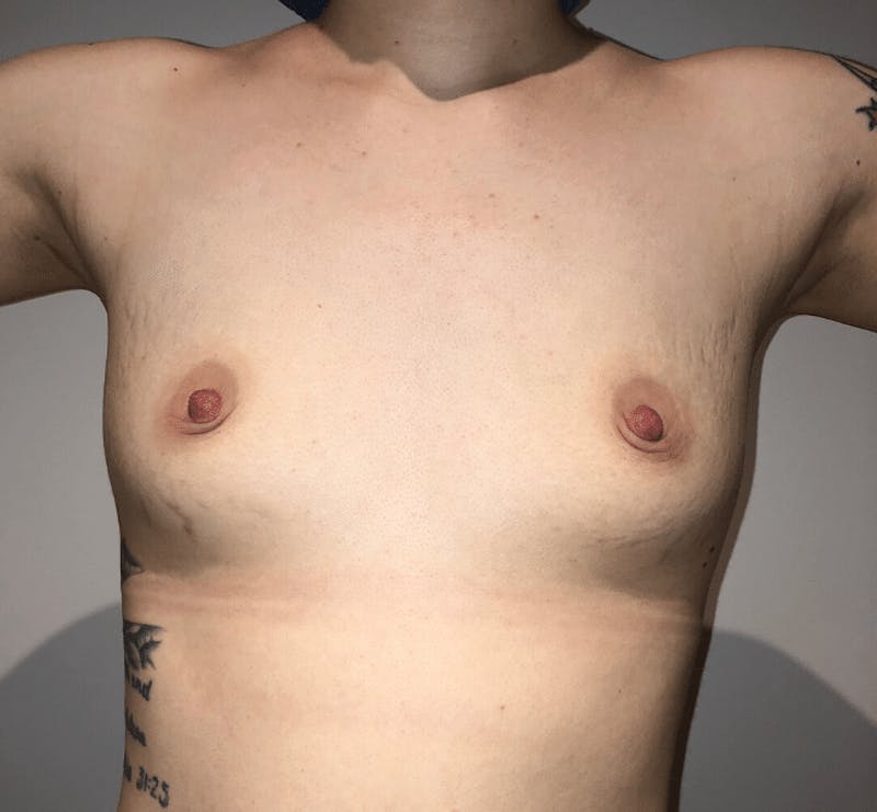 Breast Augmentation Before & After Gallery - Patient 107885 - Image 3