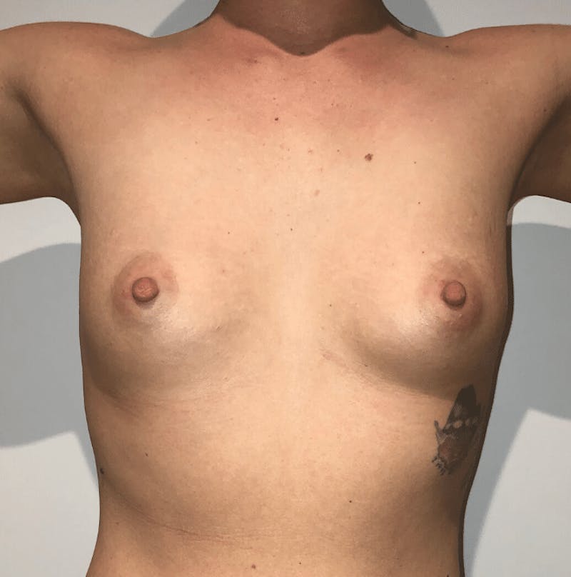 Breast Augmentation Before & After Gallery - Patient 425109 - Image 3