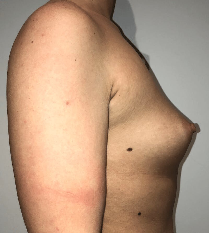 Breast Augmentation Before & After Gallery - Patient 425109 - Image 7