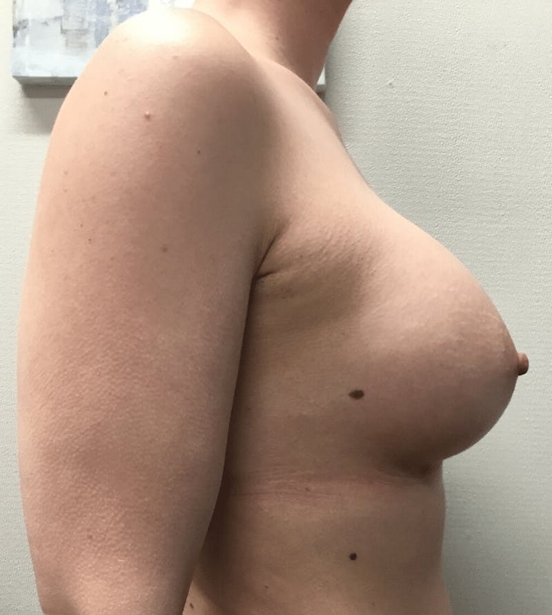 Breast Augmentation Before & After Gallery - Patient 425109 - Image 8