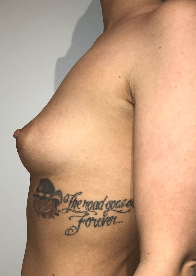 Breast Augmentation Before & After Gallery - Patient 425109 - Image 9