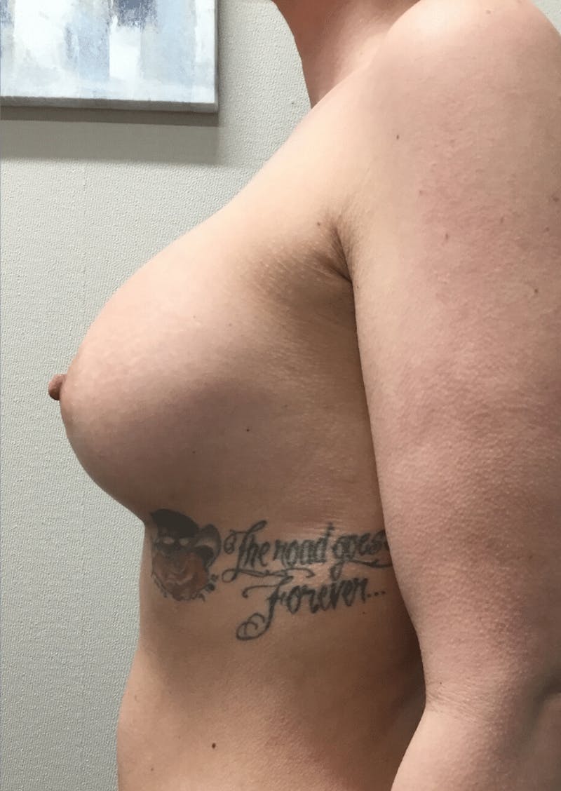 Breast Augmentation Before & After Gallery - Patient 425109 - Image 10