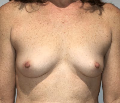 Breast Augmentation Before & After Gallery - Patient 269607 - Image 1