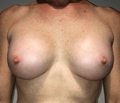 Breast Augmentation Before & After Gallery - Patient 269607 - Image 2