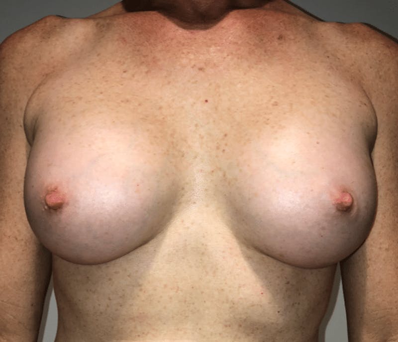 Breast Augmentation Before & After Gallery - Patient 269607 - Image 2