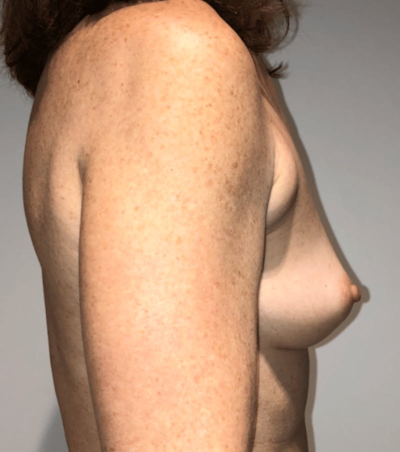 Breast Augmentation Before & After Gallery - Patient 269607 - Image 7