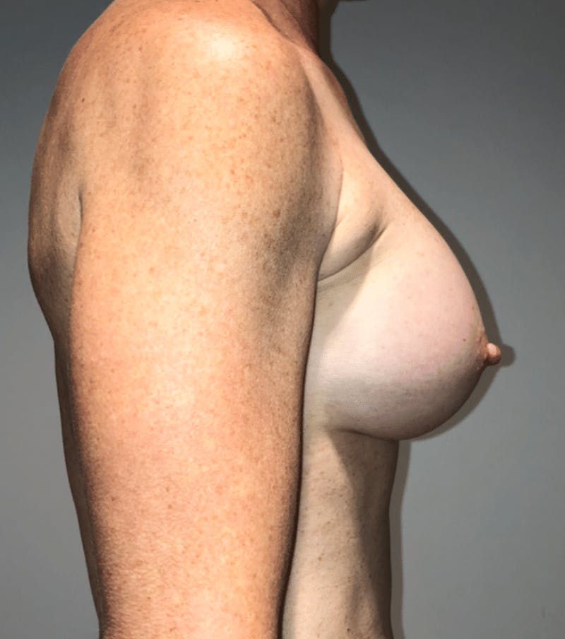 Breast Augmentation Before & After Gallery - Patient 269607 - Image 8