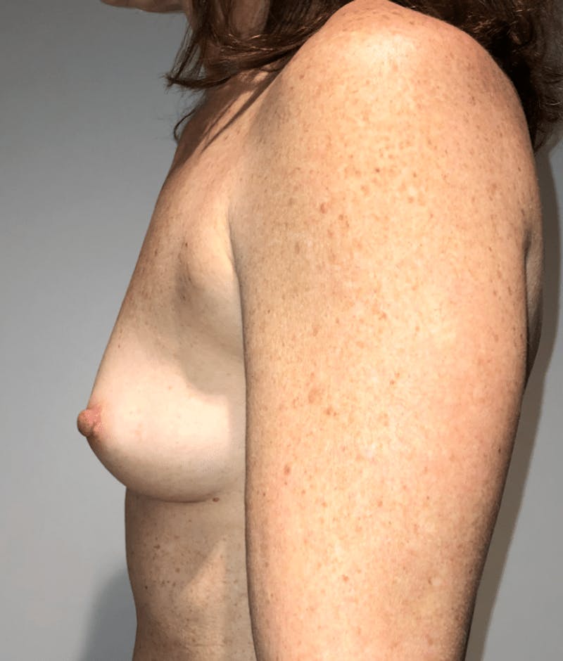 Breast Augmentation Before & After Gallery - Patient 269607 - Image 9